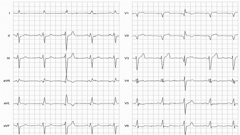 Fusion of ventricular and normal beats 12 Lead EKG